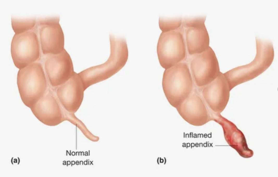 Apandisit nedir? Apandisit gereksiz bir organ mı? 15